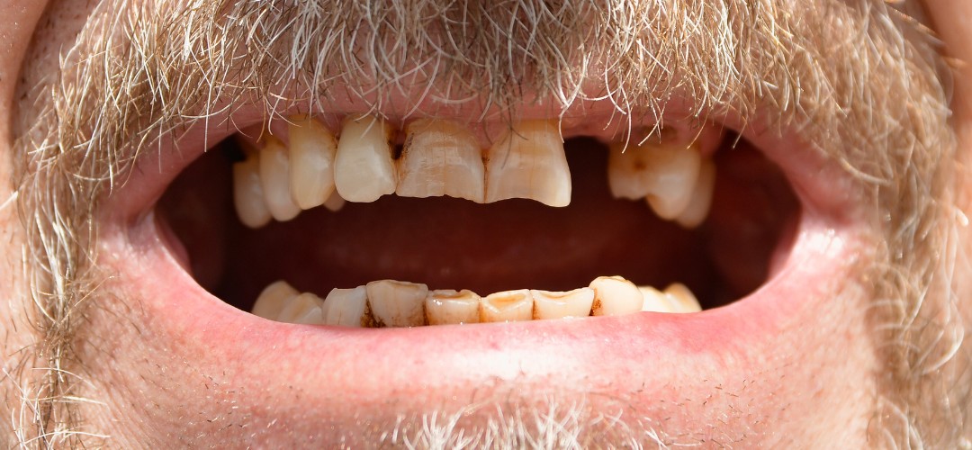 Implantes dentales en Andoain